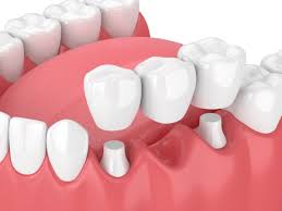 Cầu răng sứ là gì? Và cầu răng sứ tồn tại trong bao lâu?