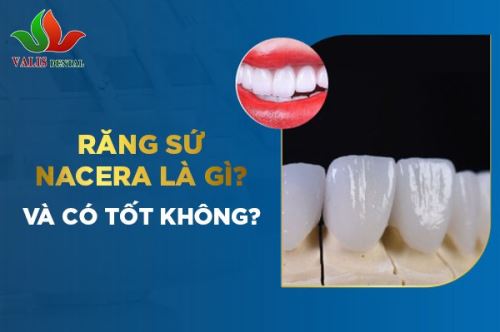 Răng sứ Nacera là gì và có tốt không?