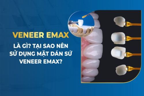 Veneer Emax Là Gì? Tại Sao Nên Sử Dụng Mặt Dán Sứ Veneer Emax?