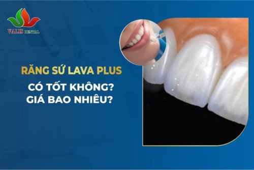 Răng Sứ Lava Plus Là Gì? Có Tốt Không?
