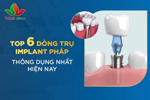 TOP 6 DÒNG TRỤ IMPLANT PHÁP THÔNG DỤNG NHẤT HIỆN NAY