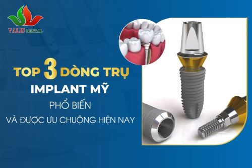 Top 3 Dòng Trụ Implant Mỹ Phổ Biến Và Được Ưa Chuộng Hiện Nay