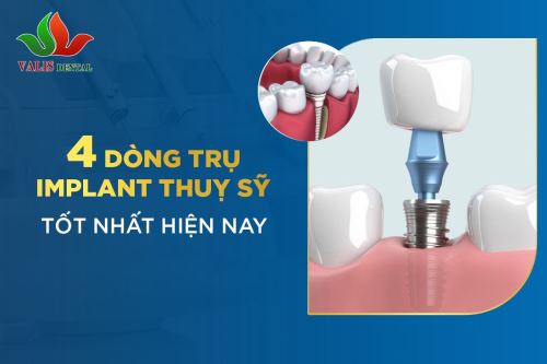 4 dòng trụ Implant Thụy Sĩ tốt hiện nay