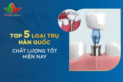 Top 5 loại trụ Implant Hàn Quốc chất lượng tốt hiện nay