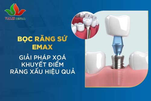 Bọc răng sứ Emax – Giải pháp xóa khuyết điểm răng xấu hiệu quả