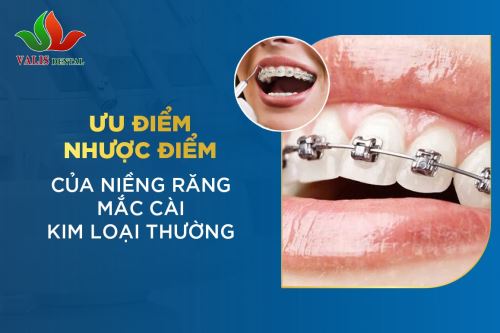 Ưu, nhược điểm của niềng răng mắc cài kim loại thường