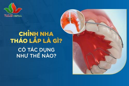 Chỉnh nha tháo lắp là gì? Có tác dụng như thế nào?
