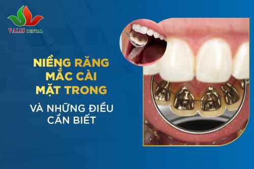 Niềng răng mắc cài mặt trong và những điều cần biết