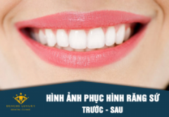 CHI PHÍ BỌC RĂNG SỨ THẨM MỸ BAO NHIÊU LÀ HỢP LÝ NHẤT? [CHĂM SÓC NHA KHOA]