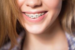 Các loại niềng răng mắc cài