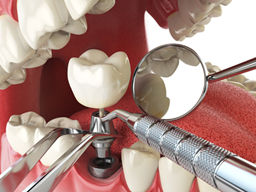 Cấy ghép Implant