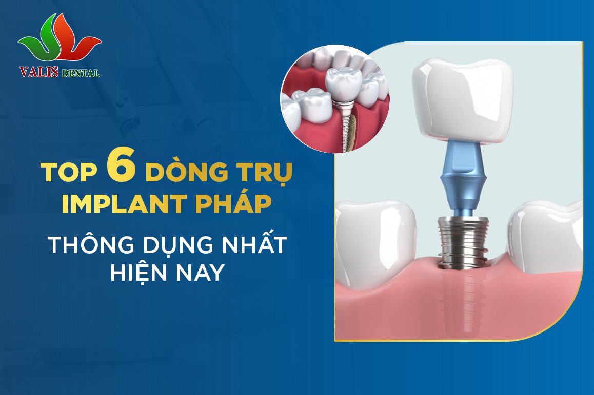 TOP 6 DÒNG TRỤ IMPLANT PHÁP THÔNG DỤNG NHẤT HIỆN NAY
