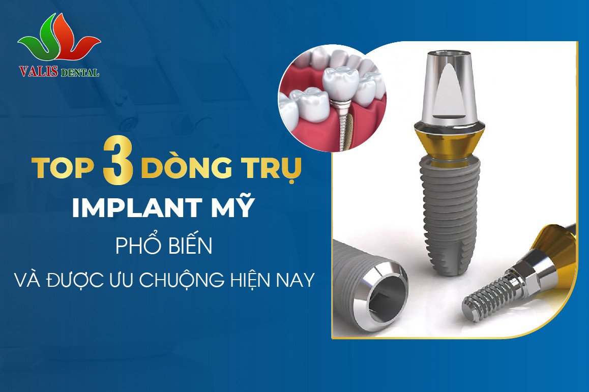 Top 3 Dòng Trụ Implant Mỹ Phổ Biến Và Được Ưa Chuộng Hiện Nay