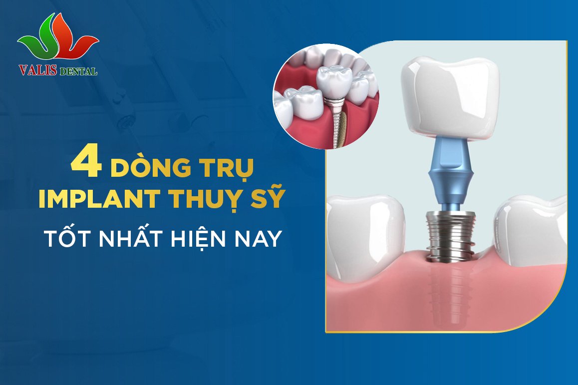 4 dòng trụ Implant Thụy Sĩ tốt hiện nay