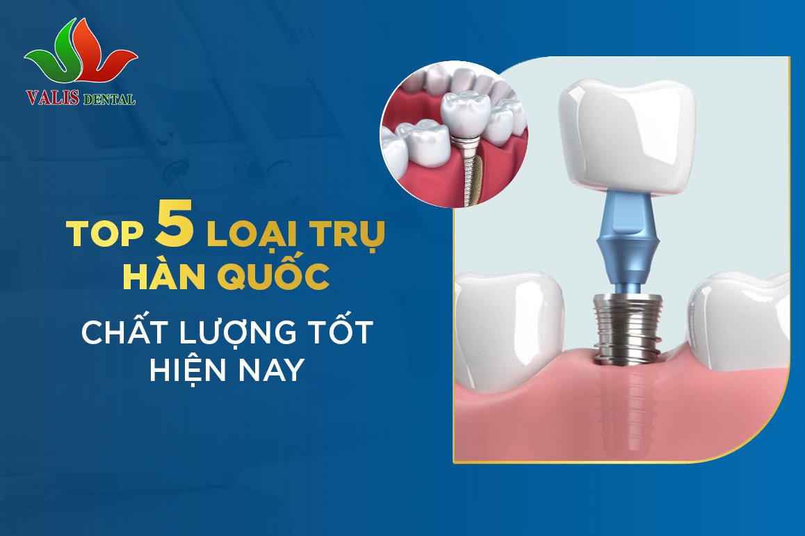Top 5 loại trụ Implant Hàn Quốc chất lượng tốt hiện nay